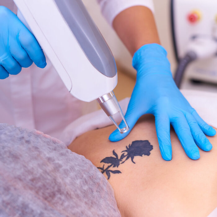 Laser tattoo removal in a cosmetology clinic.