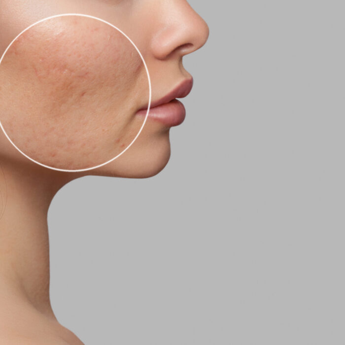 Photo before and after treatment for acne. A young girl with a problem skin. Skin treatments. Cosmetology and professional skin care.