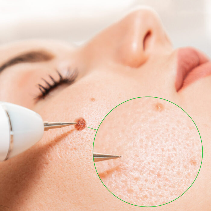 Electrocoagulation and laser cosmelotogy. Removal of birthmark from female face. Dermatologist surgeon using a professional electrocautery for removing mole. Comparison of results before and after operation.